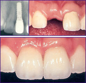 zubni implantati rekonstrukcija